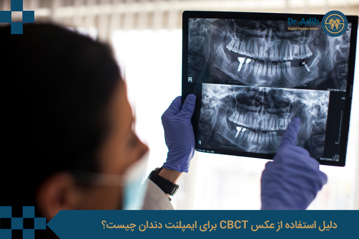دلیل استفاده از عکس CBCT برای ایمپلنت دندان چیست؟