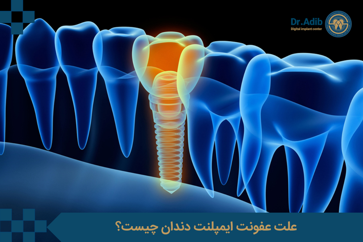 علت عفونت ایمپلنت دندان چیست؟