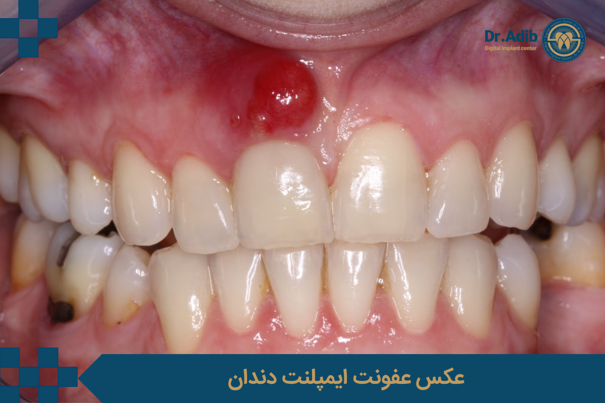 عکس عفونت ایمپلنت دندان 