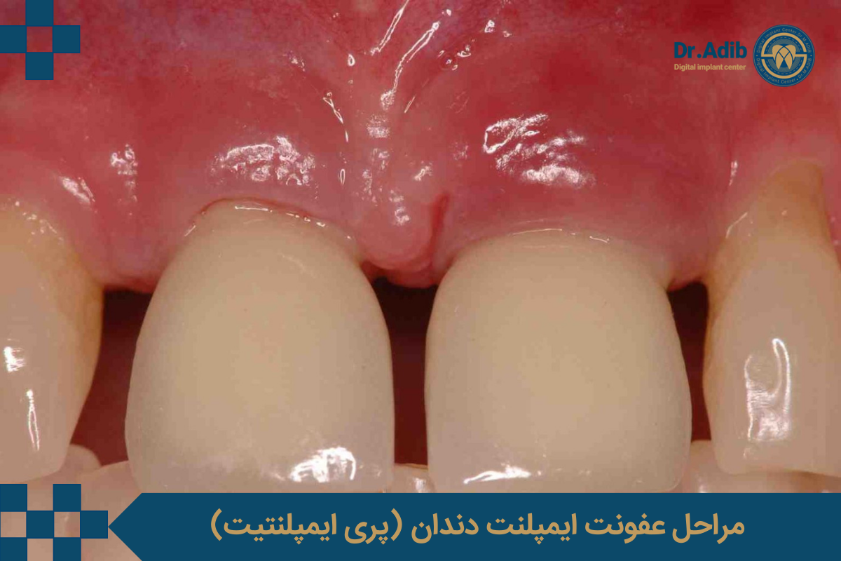 مراحل عفونت ایمپلنت دندان