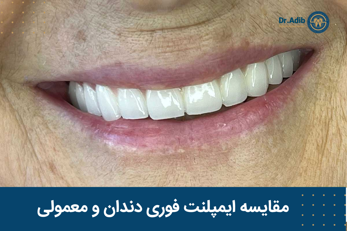 مقایسه ایمپلنت فوری دندان و معمولی