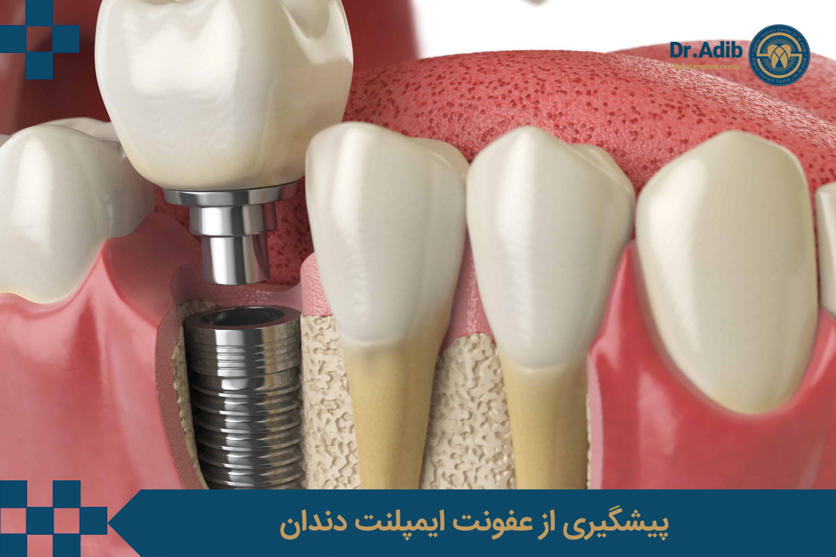 پیشگیری از عفونت ایمپلنت دندان