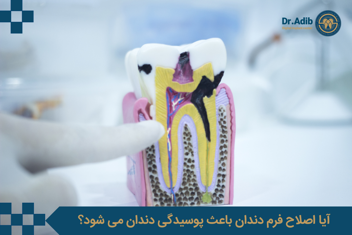 آیا اصلاح فرم دندان باعث پوسیدگی دندان می شود؟