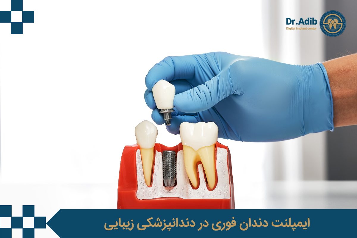 ایمپلنت دندان فوری در دندانپزشکی زیبایی