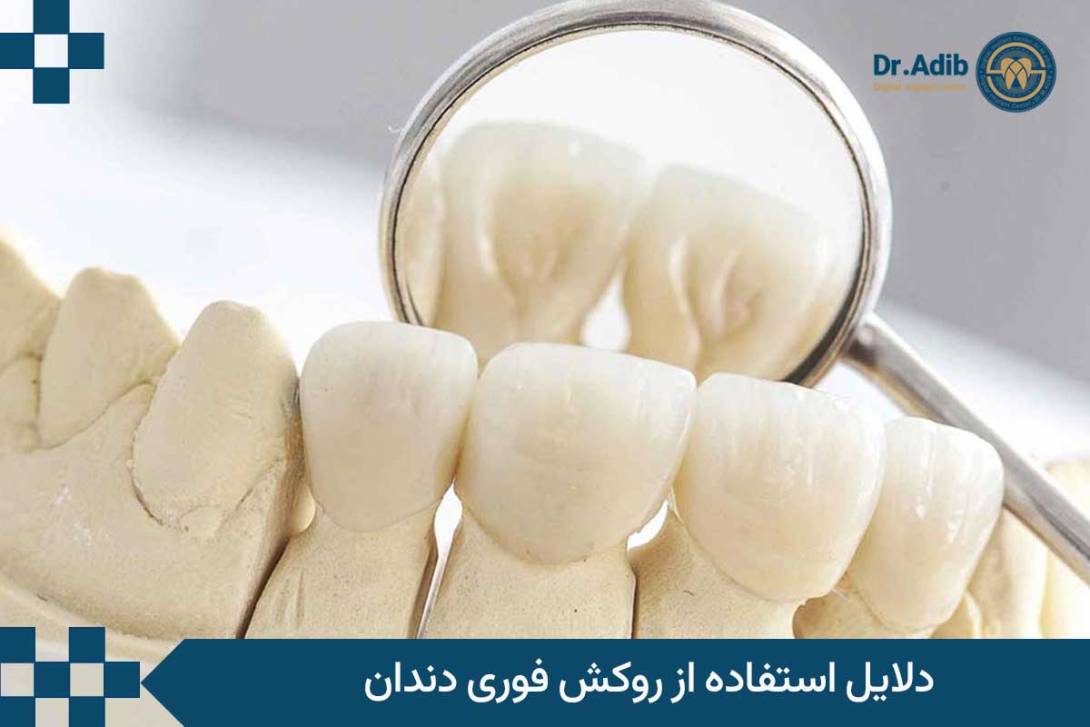 دلایل استفاده از روکش دندان