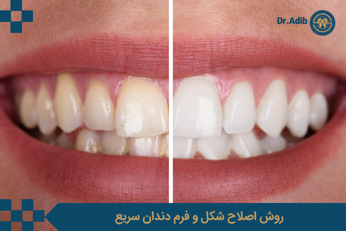 در کدام روش اصلاح شکل و فرم دندان سریعتر انجام می شود؟