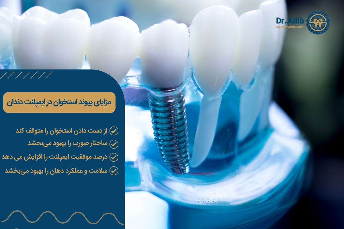 مزایای پیوند استخوان در ایمپلنت دندان