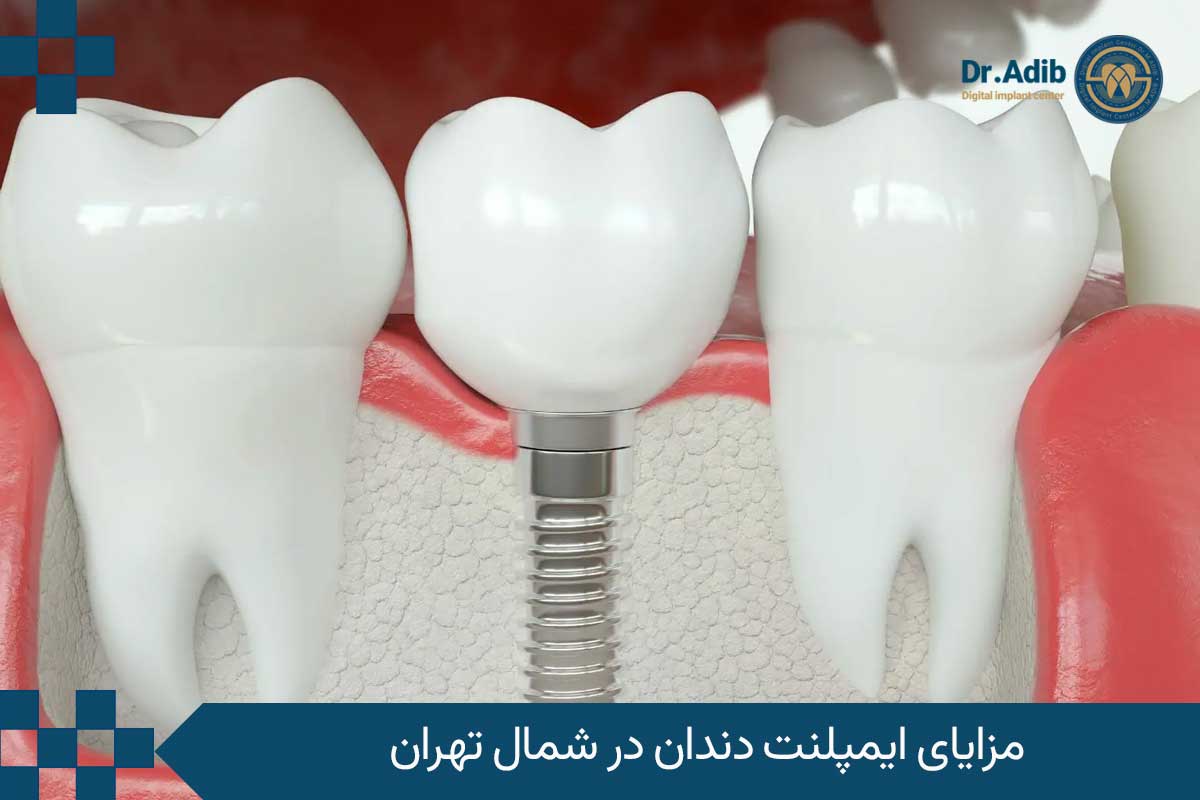مزایای ایمپلنت دندان در شمال تهران