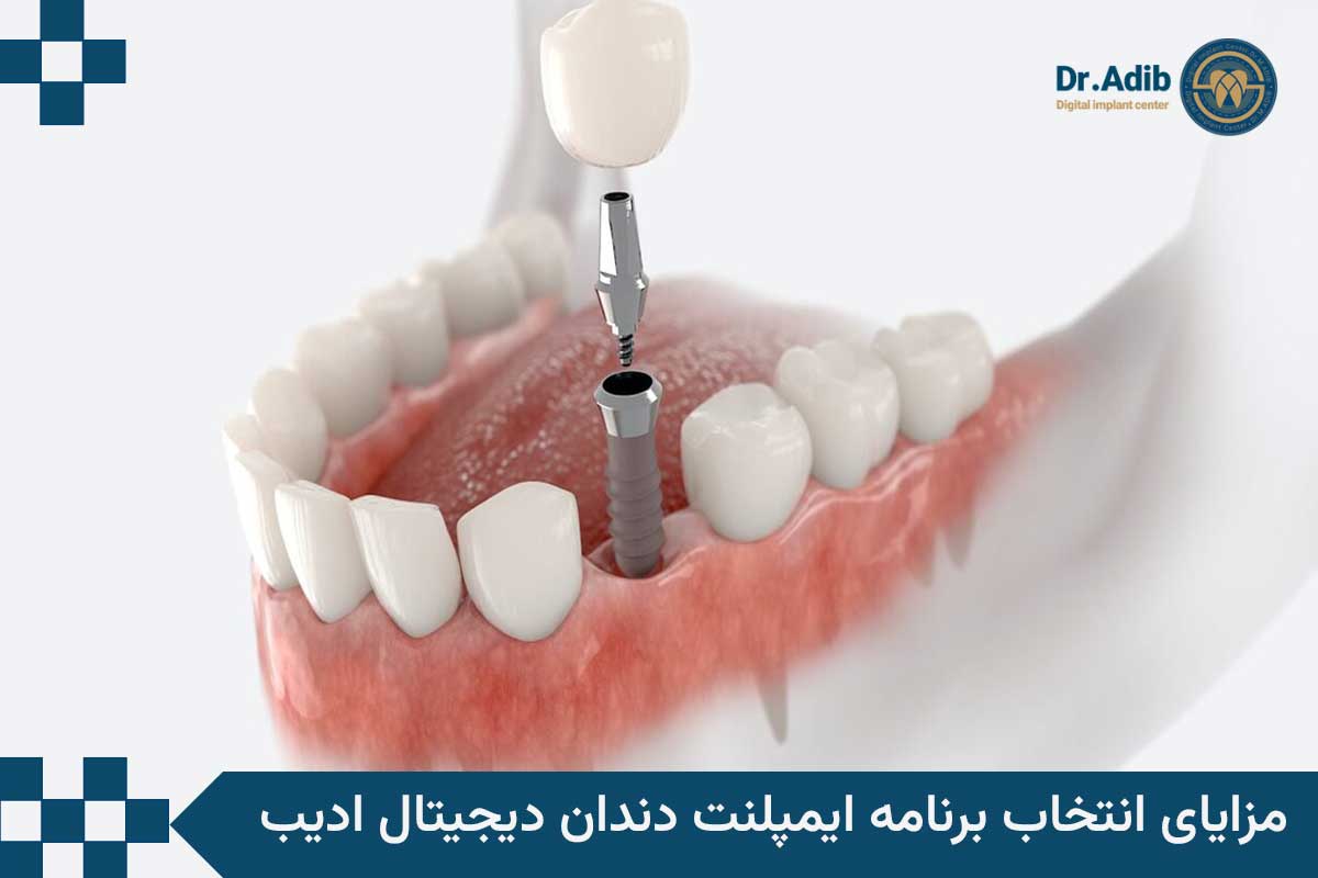 مزایا ایمپلنت دندان دیجیتال 