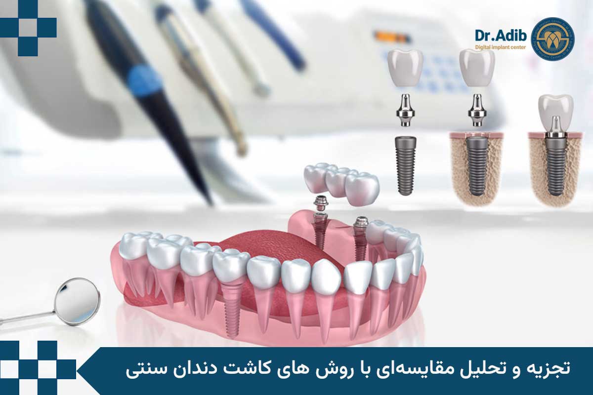 تجزیه و تحلیل مقایسه‌ای با روش های کاشت دندان سنتی