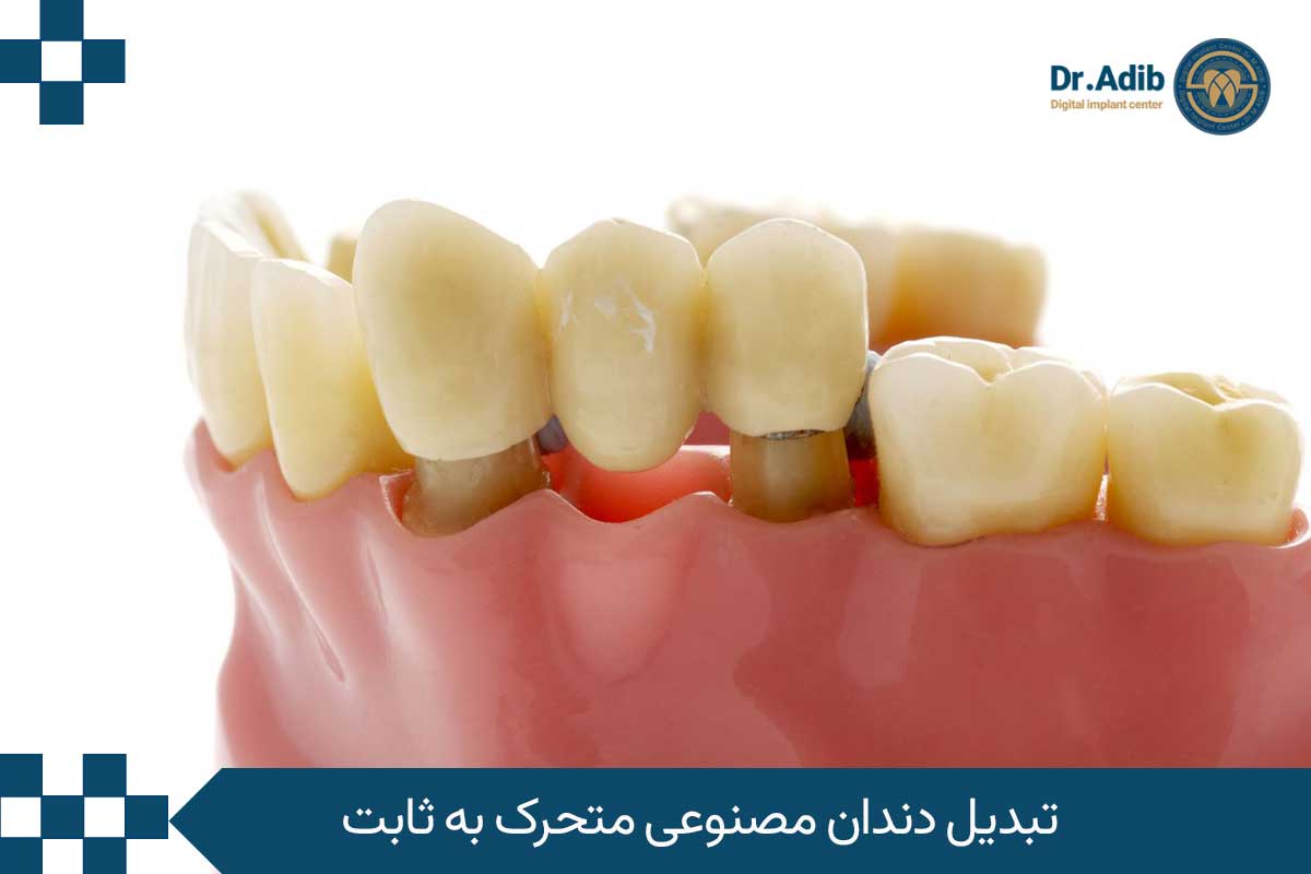 تبدیل دندان مصنوعی متحرک به ثابت با استفاده از ایمپلنت دیجیتال