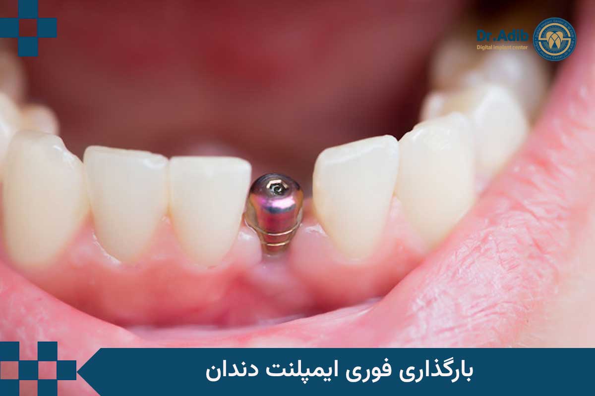 بارگذاری ایمپلنت فوری دندان