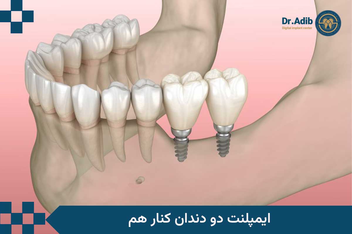 ایمپلنت دو دندان