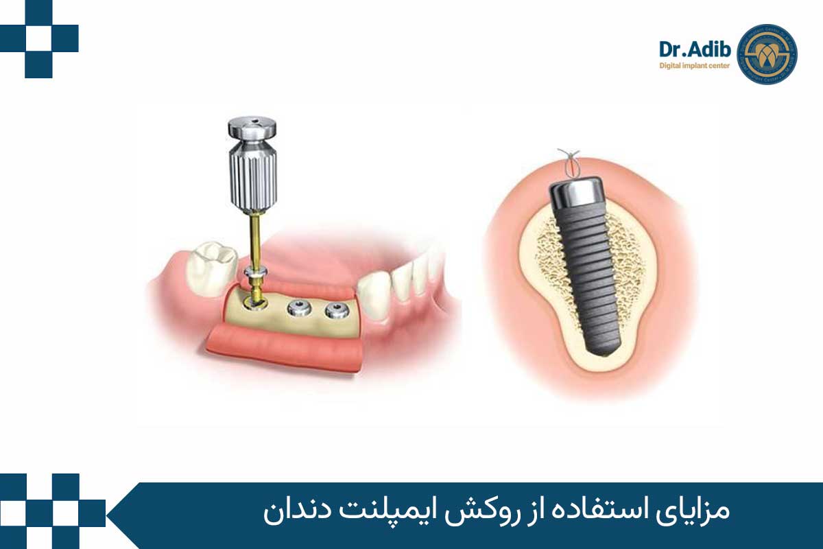 مزایای استفاده از روکش ایمپلنت دندان