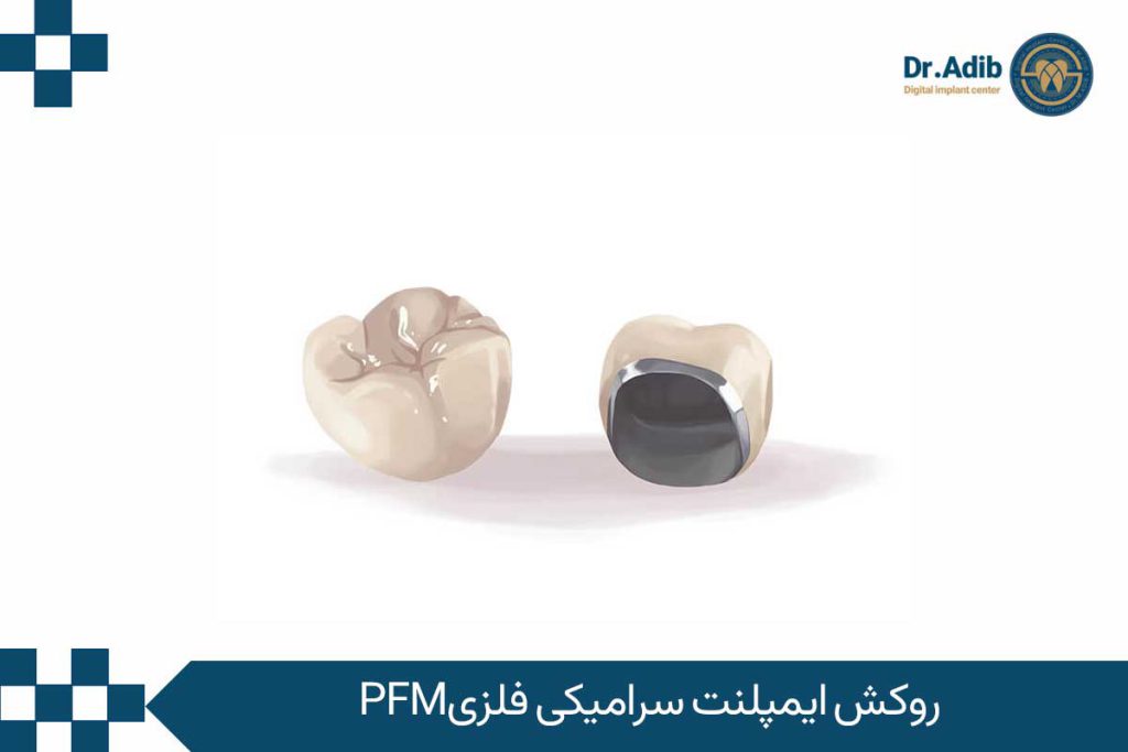PFM ceramic metal implants