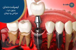 ایمپلنت دندان بدون درد، جراحی و درمان