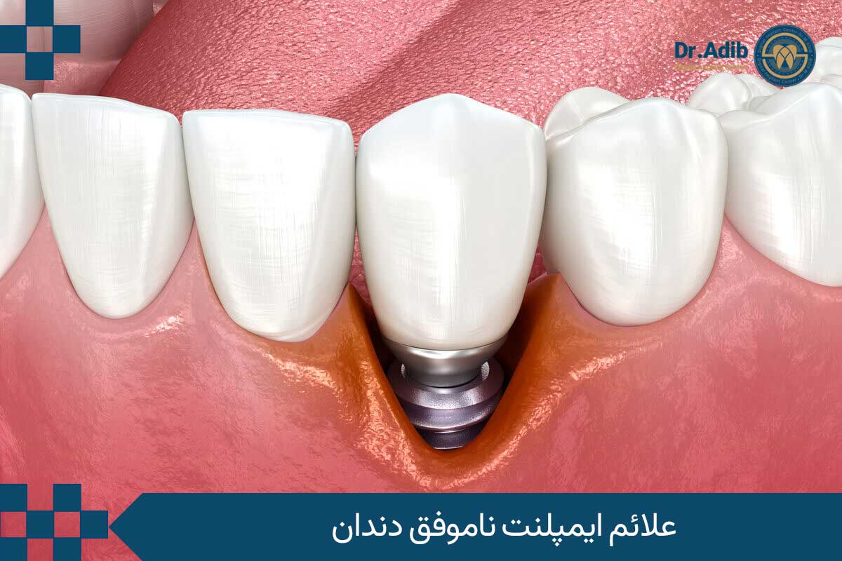 علائم ایمپلنت ناموفق دندان