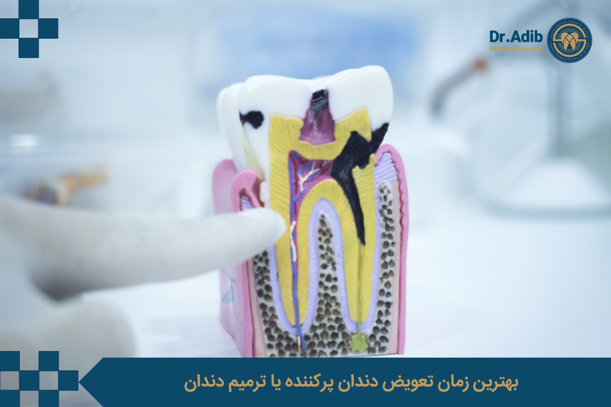 بهترین زمان تعویض دندان پرکننده یا ترمیم دندان